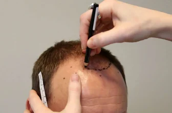 hair transplant hair line