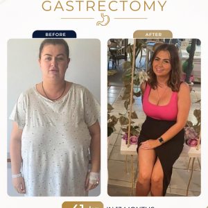 Gastric Sleeve Surgery