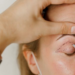Eyelid Surgery