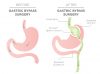 Gastric Bypass Diagram