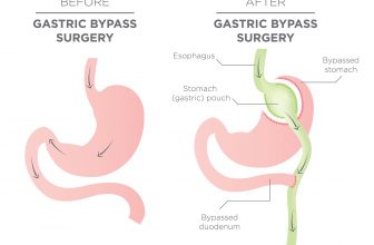 Gastric Bypass Diagram