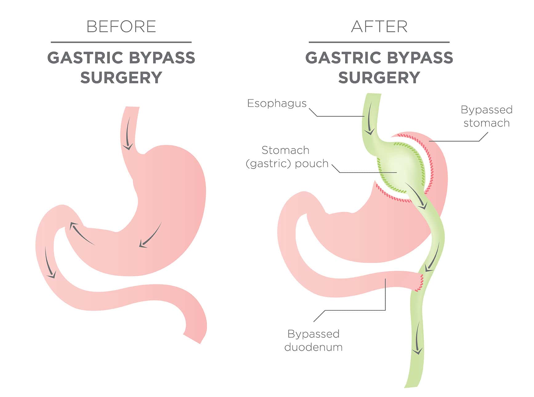 Gastric Bypass Diagram