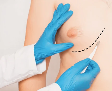 Gynecomastia