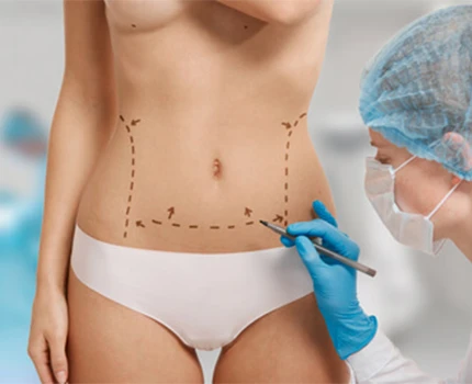 Tummy Tuck