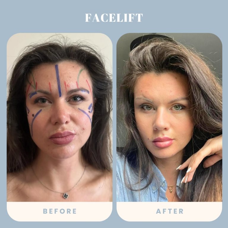 Facelift
