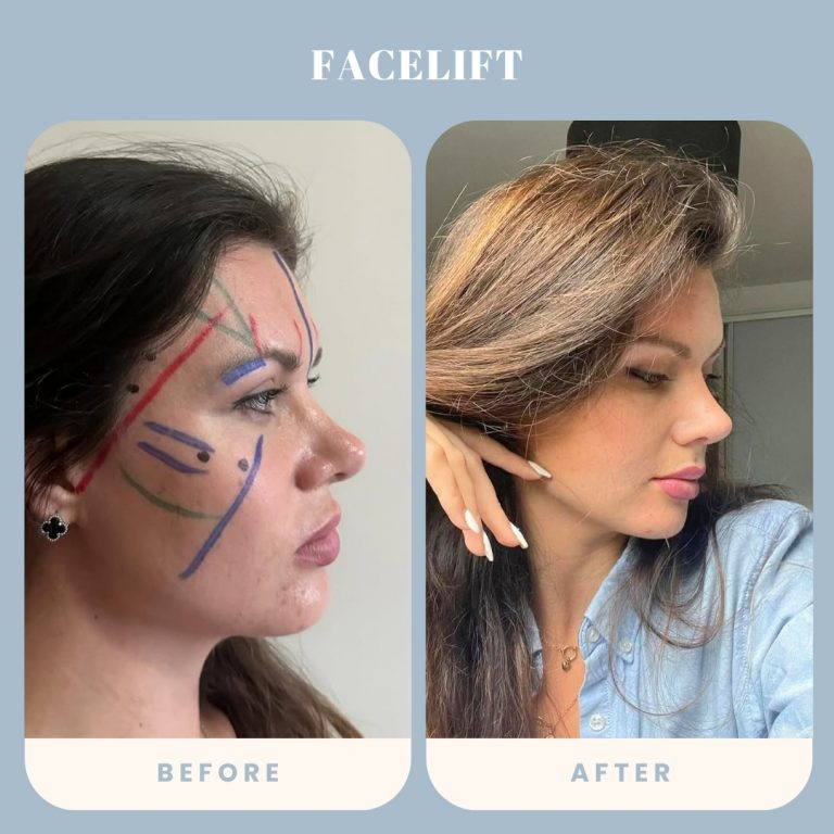 Facelift