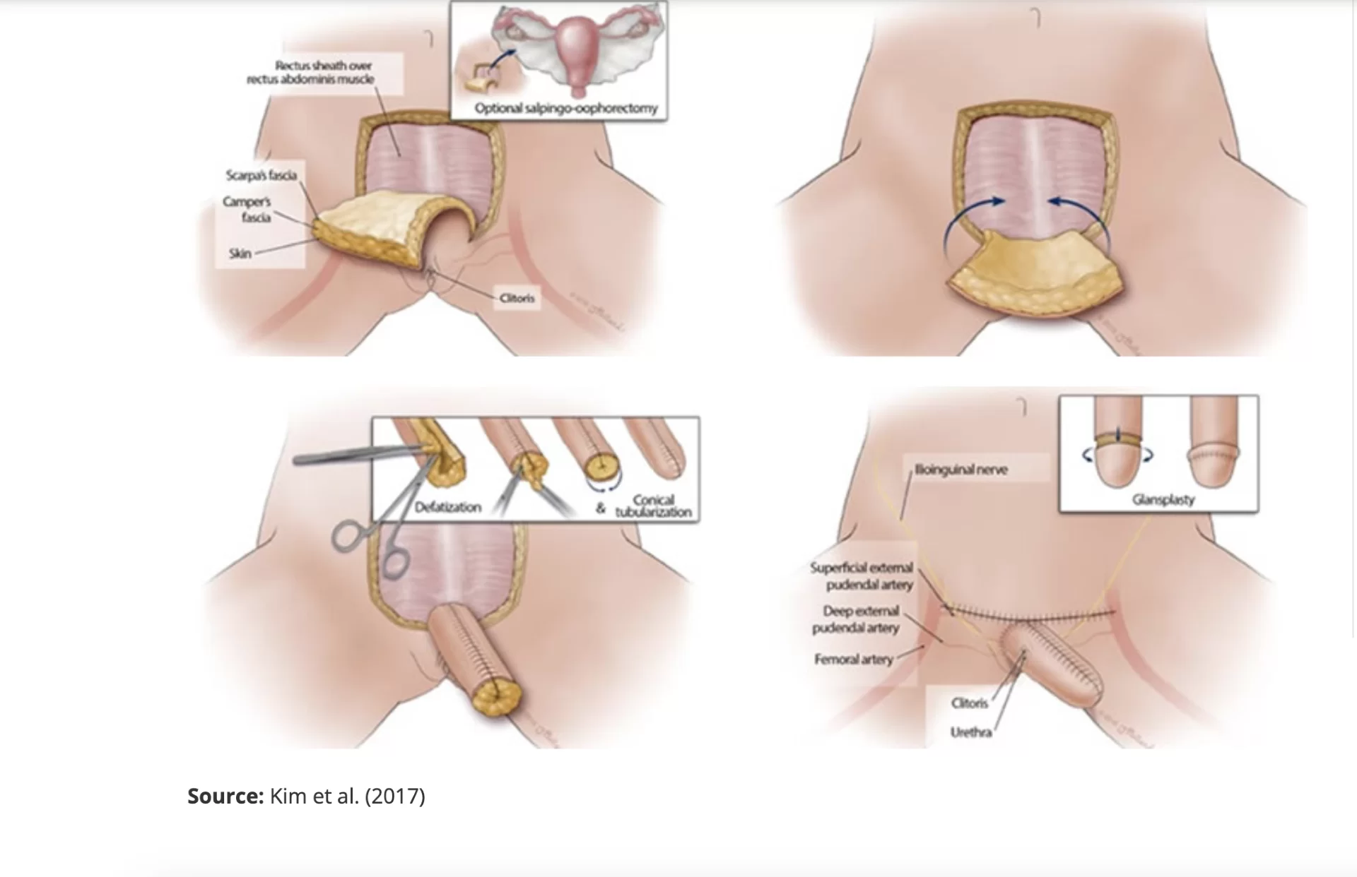 abdominophalloplasty 