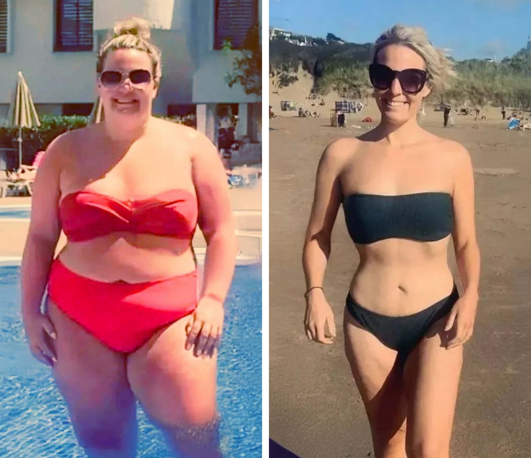Bariatric patient before and after, 38 kg weight loss in 9 months