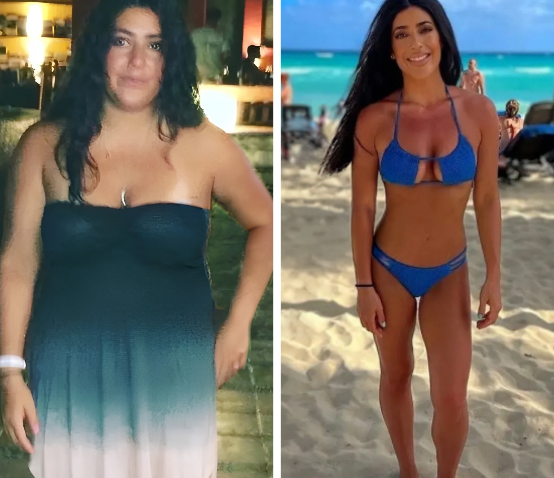 Bariatric patient before and after, 40 kg weight loss in 10 months