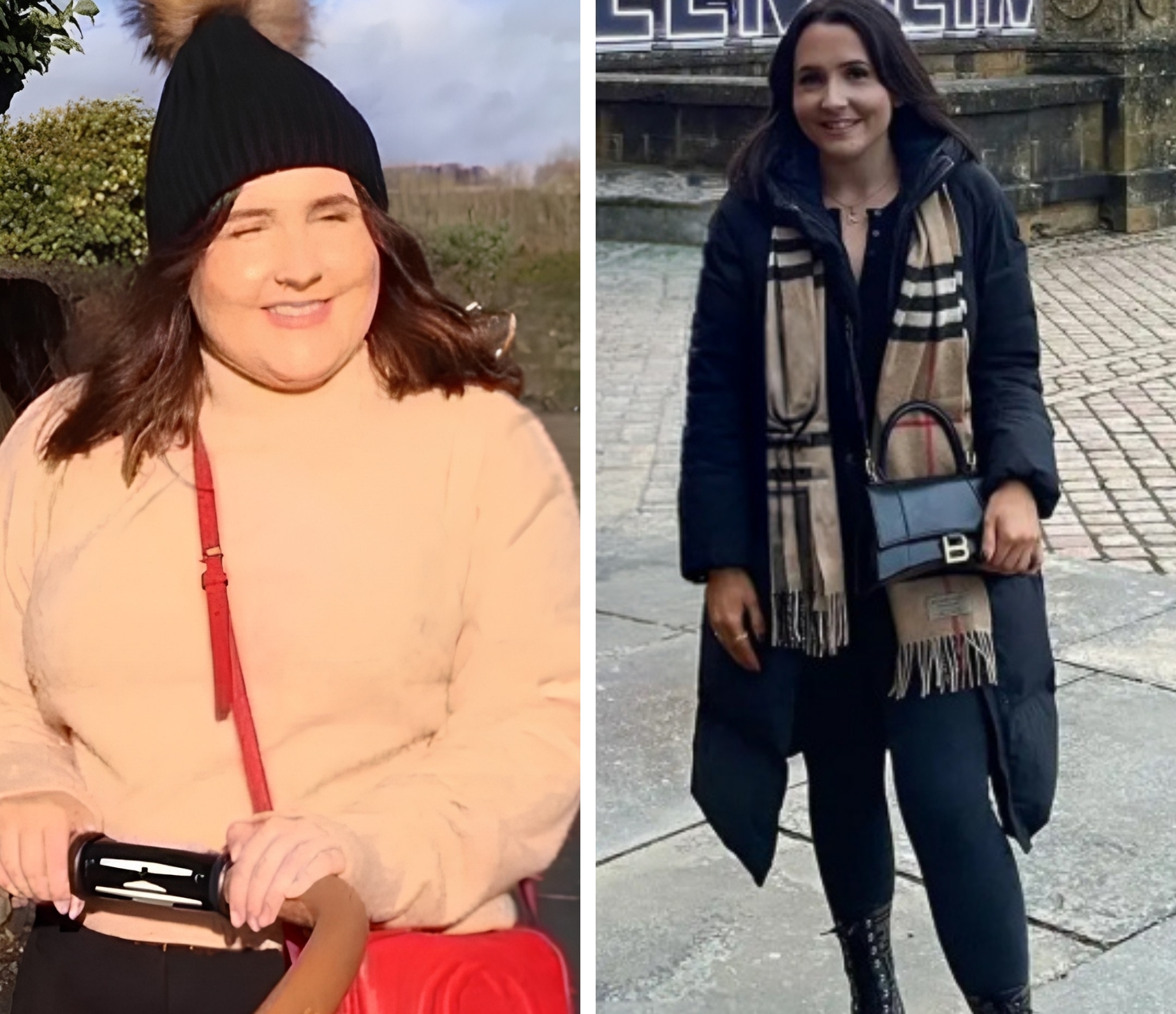 Bariatric patient before and after, 41 kg weight loss in 11 months