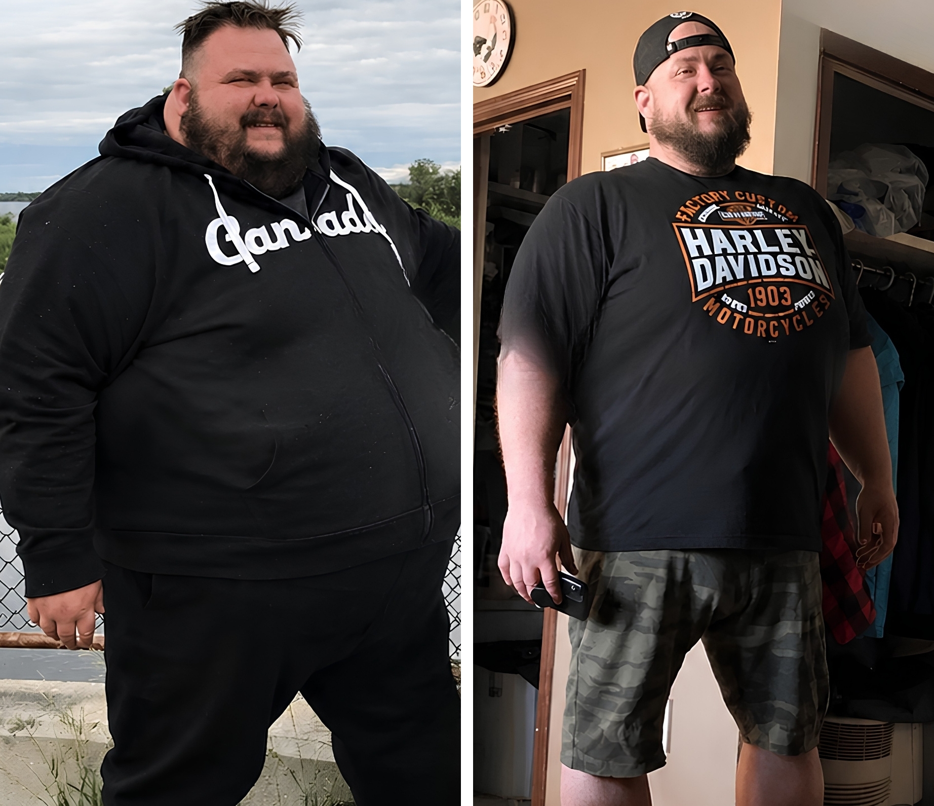 Bariatric patient before and after, 68 kg weight loss in 11 months