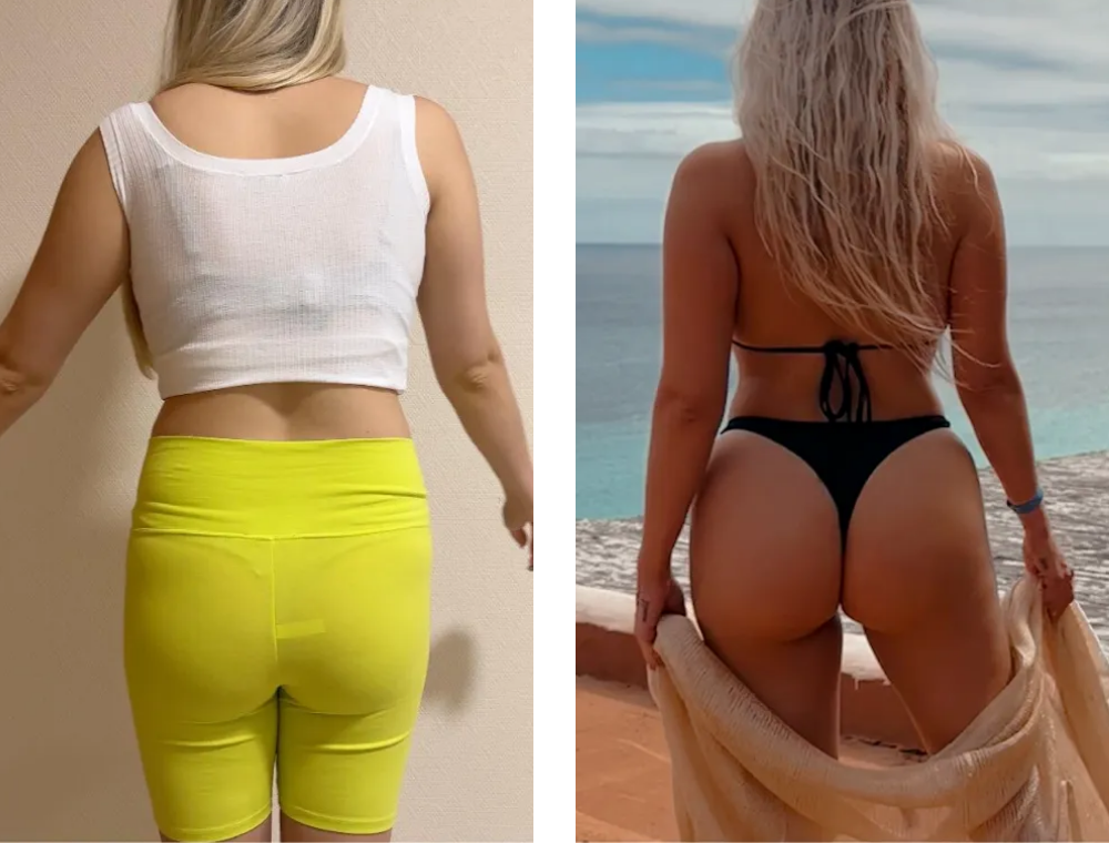 Brazilian Butt Lift before and after result at Estexper Clinic