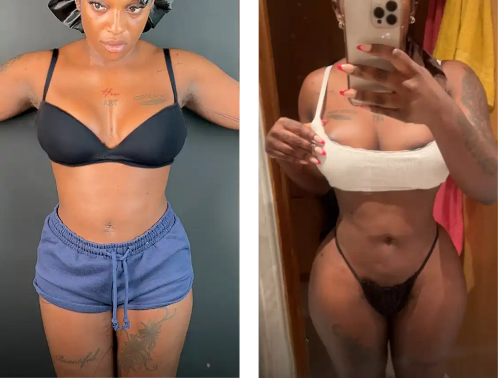 Brazilian Butt Lift before and after result at Estexper Clinic