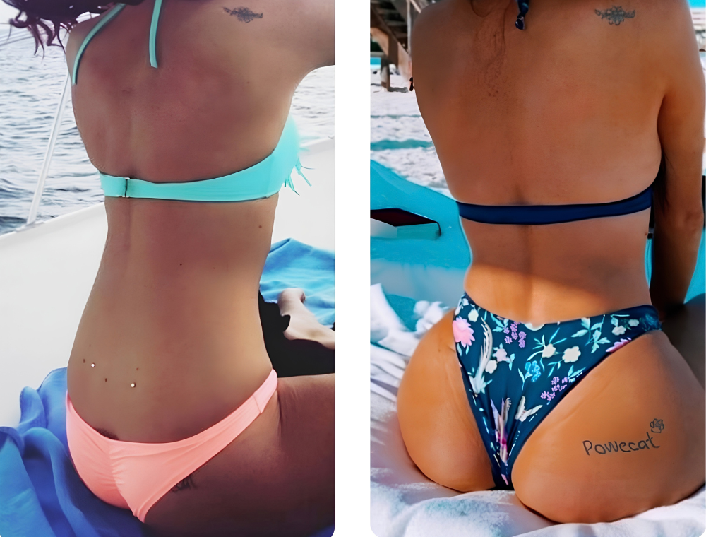 Brazilian Butt Lift before and after result at Estexper Clinic