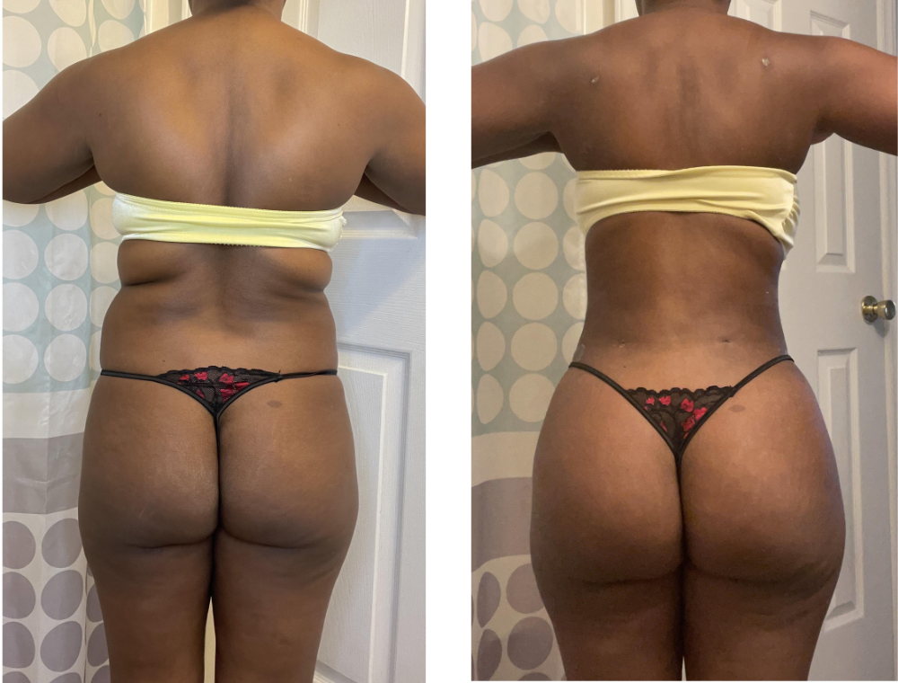 Brazilian Butt Lift before and after patient result at Estexper Clinic