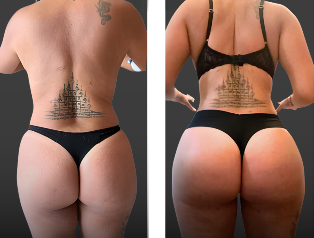 Brazilian Butt Lift before and after patient result at Estexper Clinic