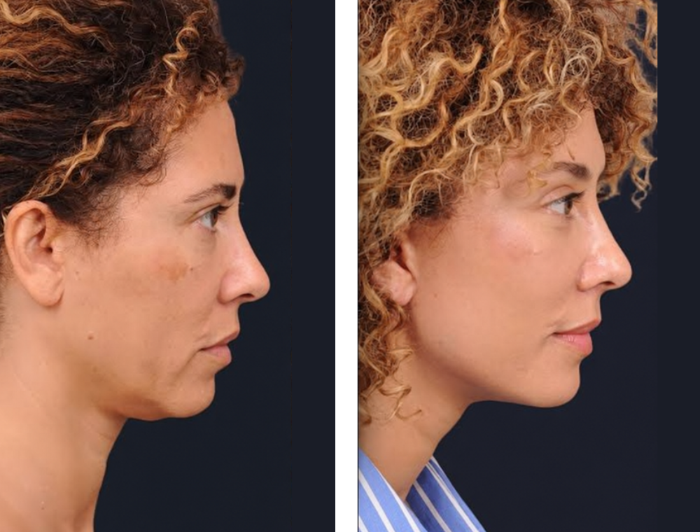 Chin aesthetic treatment comparison 1