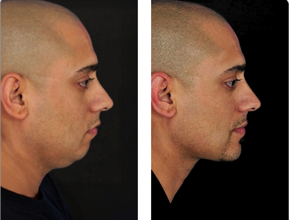 Chin aesthetic treatment comparison 2