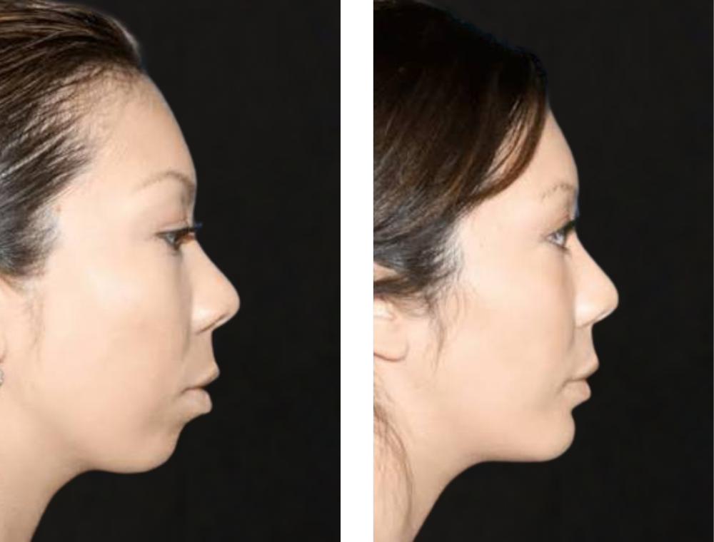 Chin aesthetic treatment comparison 4