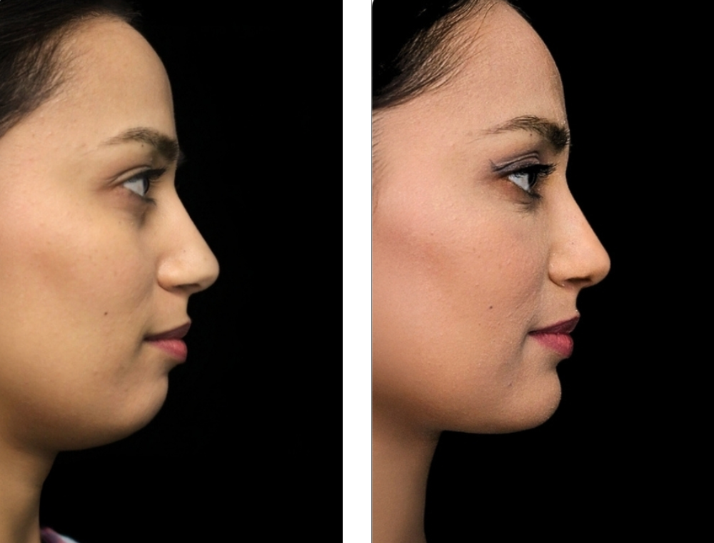 Chin aesthetic treatment comparison 5