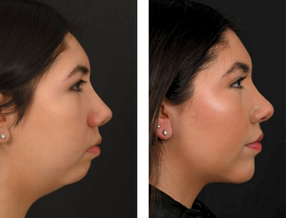 Chin aesthetic treatment comparison 6