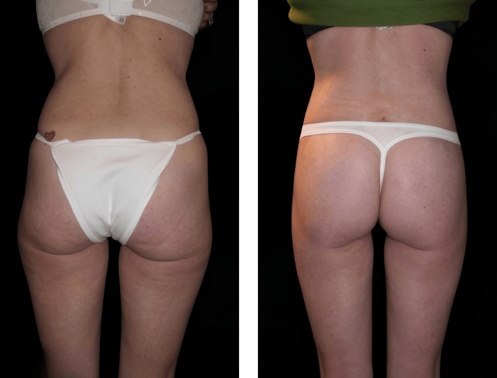 Thigh lift patient before-and-after photographs