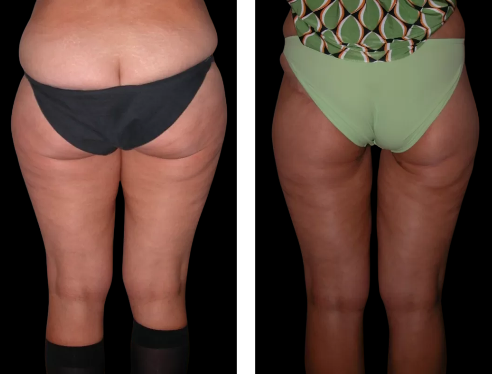 Thigh lift before and after example