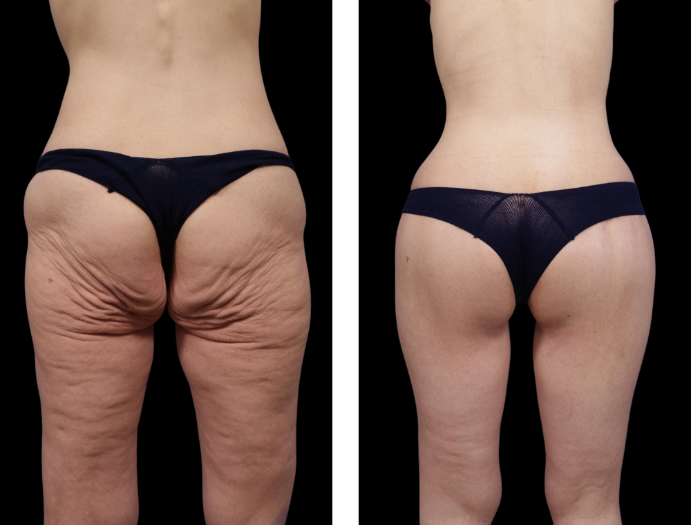 Thigh lift before and after example
