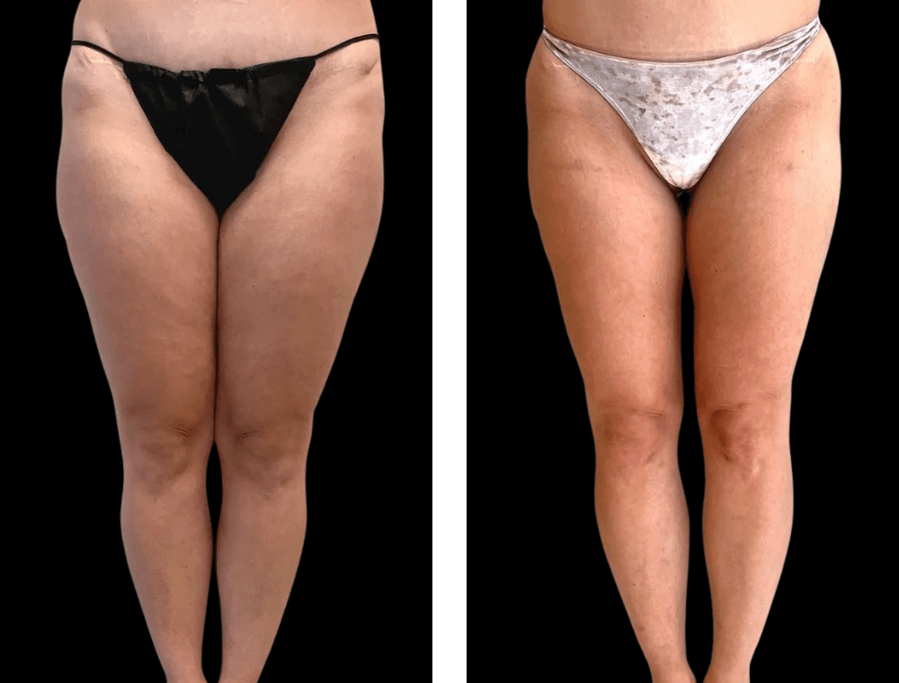 Thigh lift before and after example