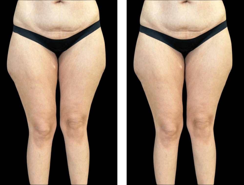 Thigh lift before and after example