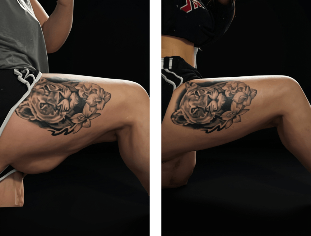 Thigh lift before and after example