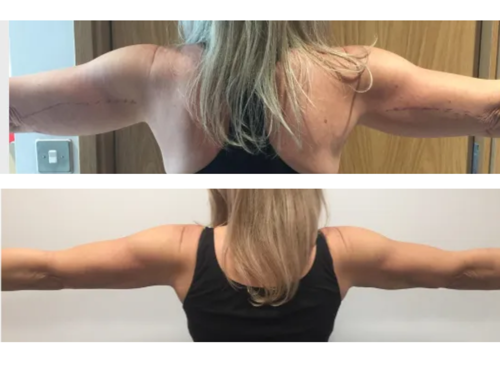 Arm lift before and after example