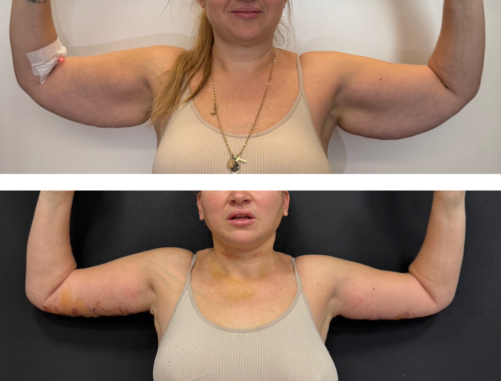 Arm lift before and after example