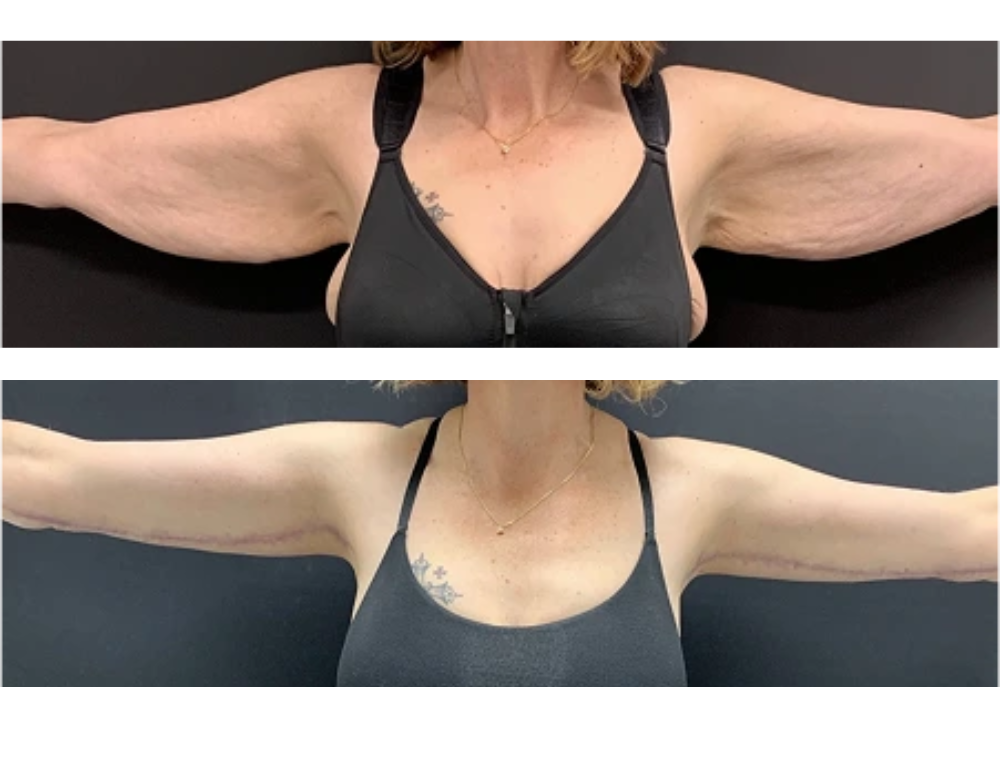 Arm lift before and after example
