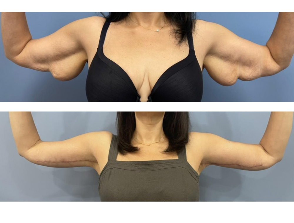 Arm lift before and after example