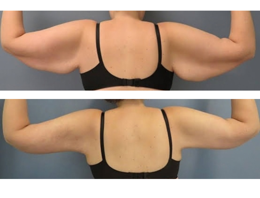 Arm lift before and after example