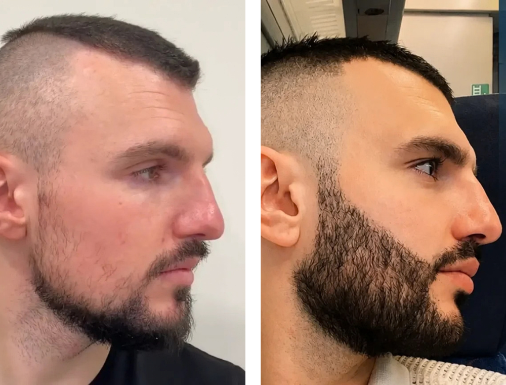 Beard transplant before-and-after patient result 1