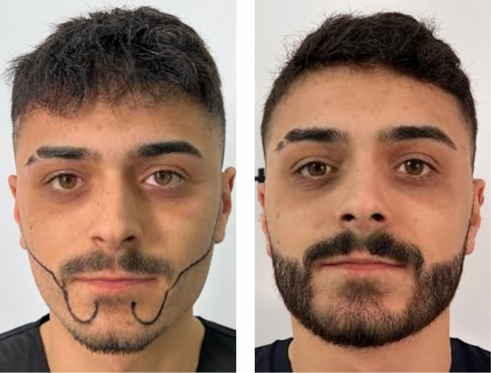 Beard transplant before-and-after patient result 2