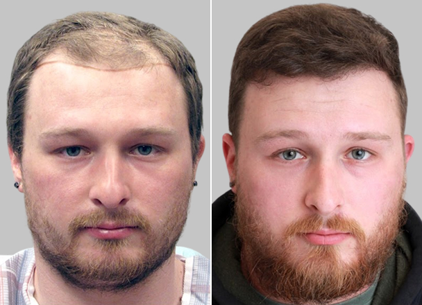 Hair transplant before and after comparison — patient example 6