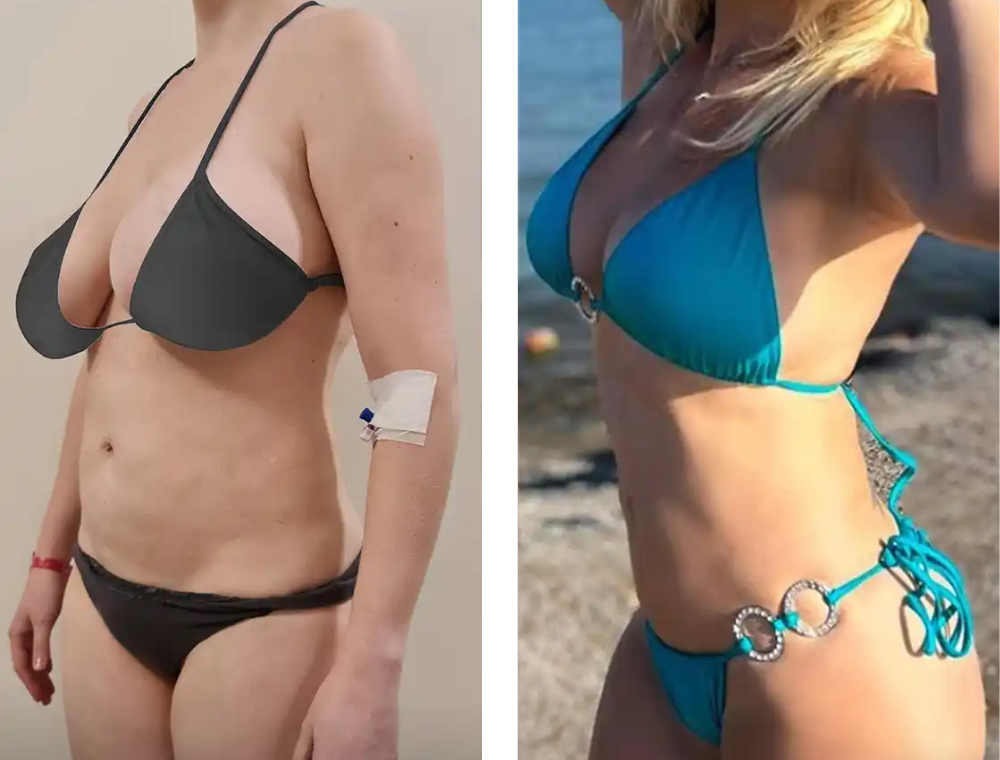Breast lift before and after patient result at Estexper Clinic