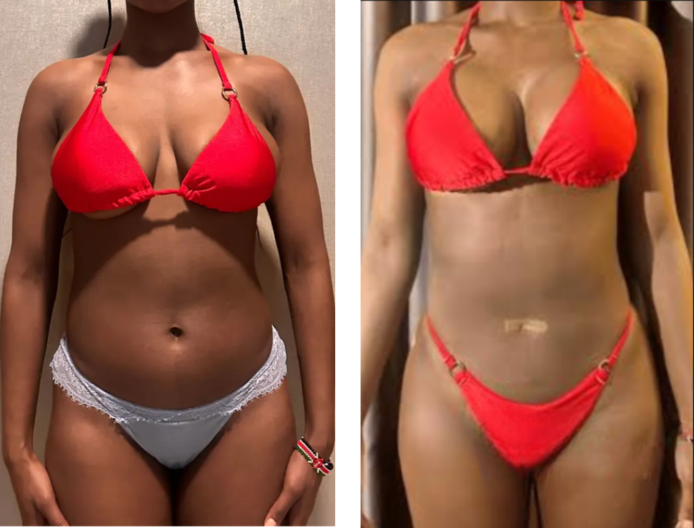 Breast lift before and after result at Estexper Clinic