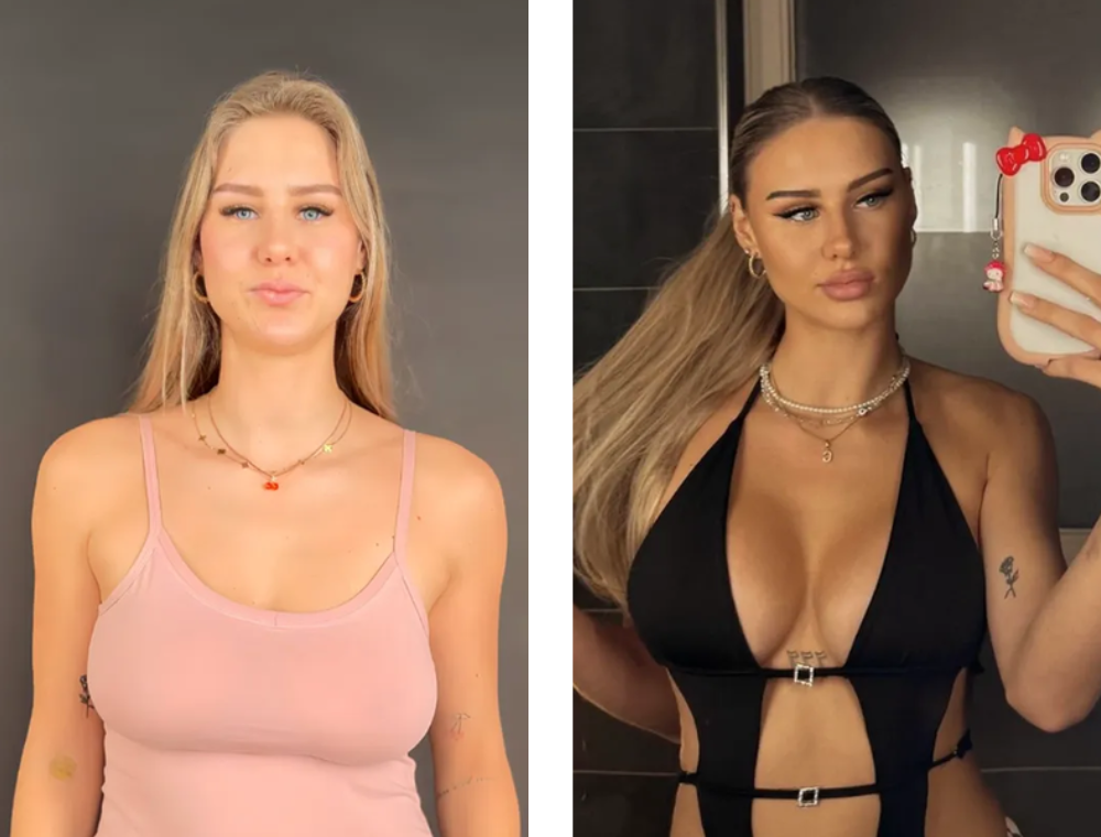 Breast lift before and after result at Estexper Clinic