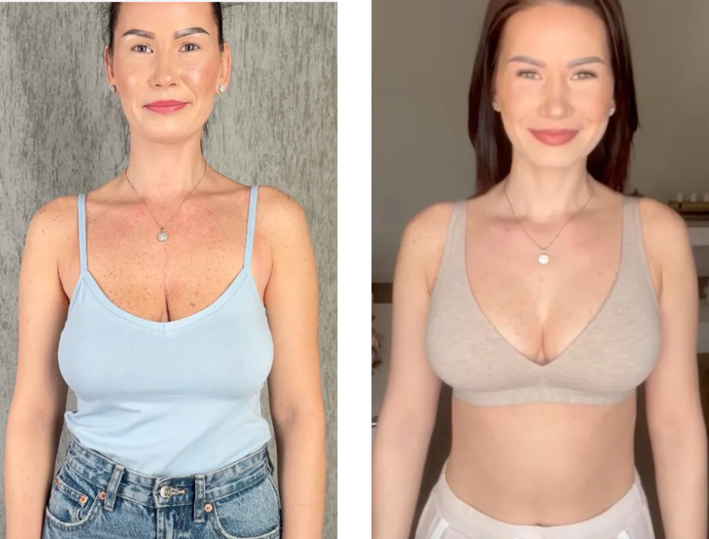 Breast lift before and after patient result at Estexper Clinic