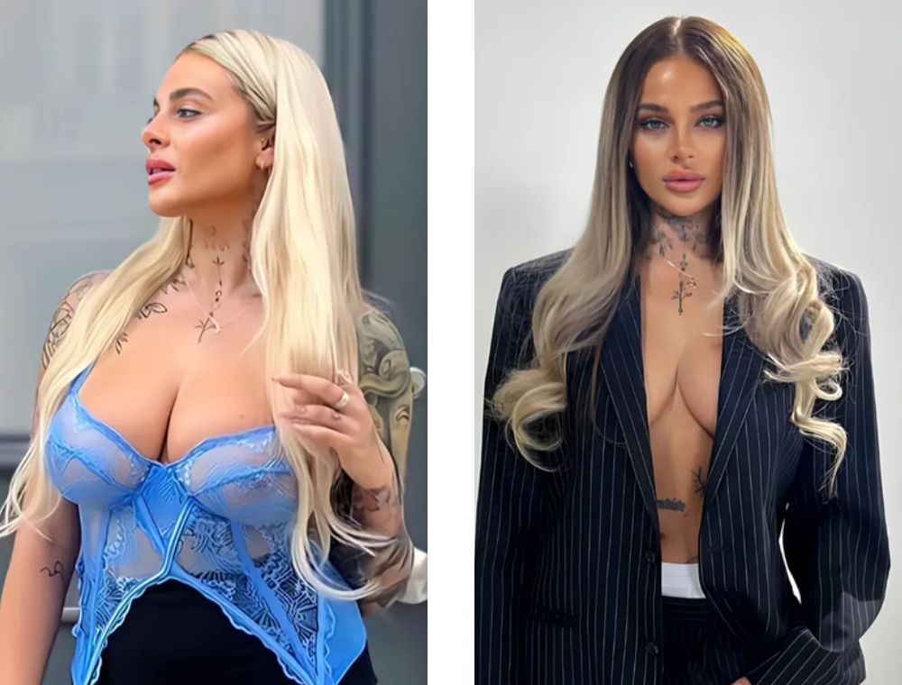 Breast lift before and after result at Estexper Clinic