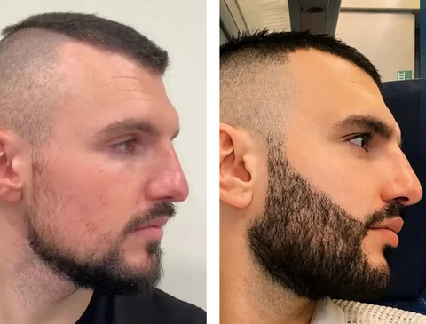 Beard transplant before-and-after patient result 1
