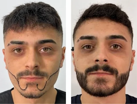 Beard transplant before-and-after patient result 2