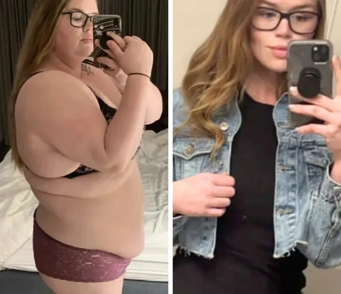 Bariatric patient before and after, 49 kg weight loss in 11 months
