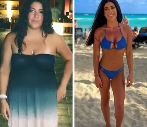 Bariatric patient before and after, 40 kg weight loss in 10 months