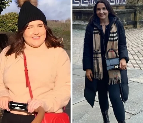 Bariatric patient before and after, 41 kg weight loss in 11 months
