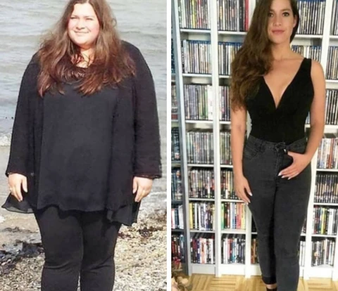 Bariatric patient before and after, 48 kg weight loss in 13 months